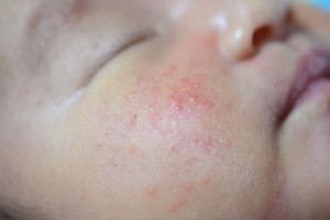 赤ちゃんの湿疹