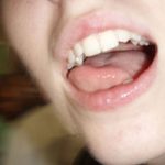 【口から出る臭い塊】膿栓の原因と出さない方法は？